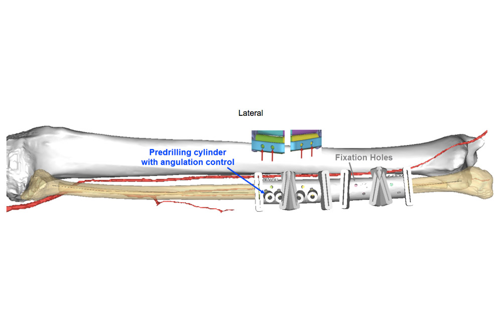 VSP for Patient-Specific Reconstructive Microsurgery Case Study Figure 4a